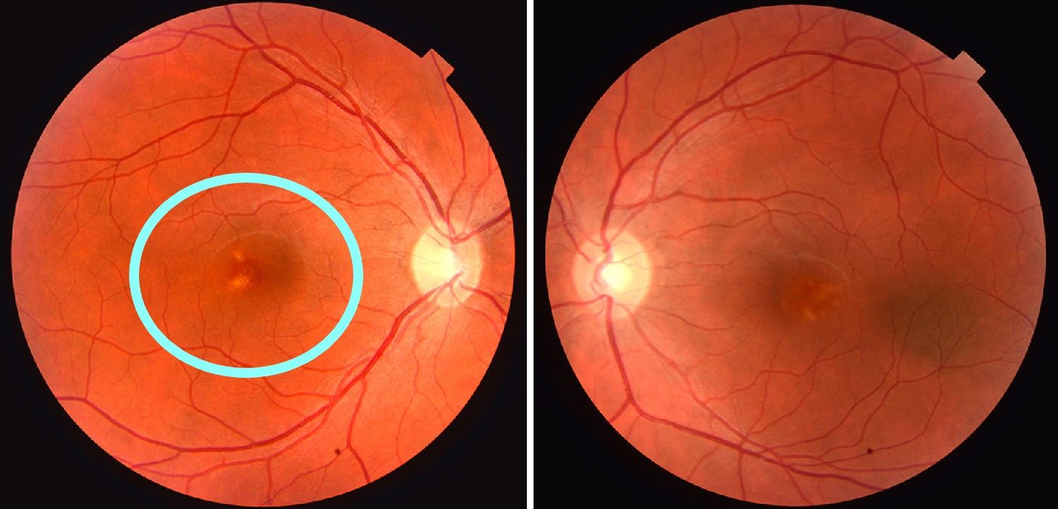 Usar gafas de sol para ver eclipse puede ocasionar ceguera irreversible - Retinopatía-Ocular-Edición-foto-de-Elsevier