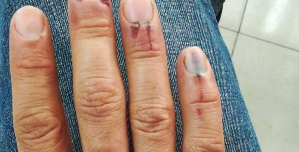 #Video Nuevo ataque de un pitbull en la Cuauhtémoc - ataque-de-perro-1024x521