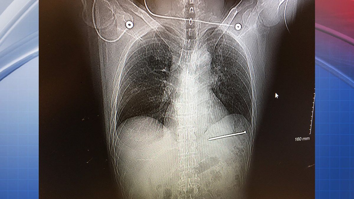 Hombre sobrevive disparo accidental de pistola de clavos - clavo