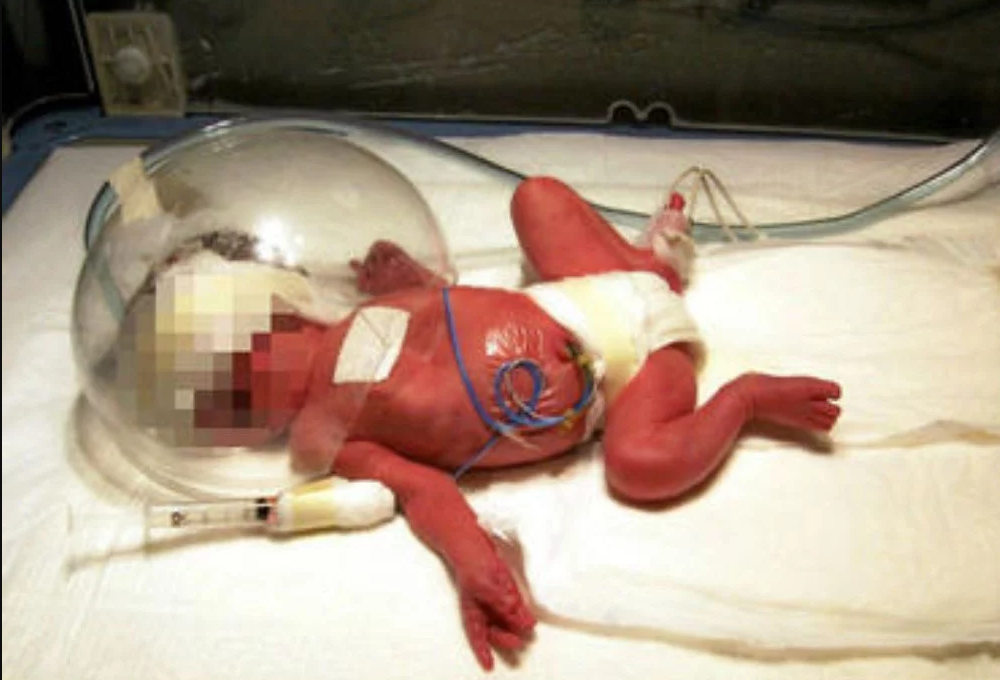 Tras siete meses, bebé que nació con 400 gramos se recupera - Foto-de-El-Informador-Bebé-prematuro-400-gramos