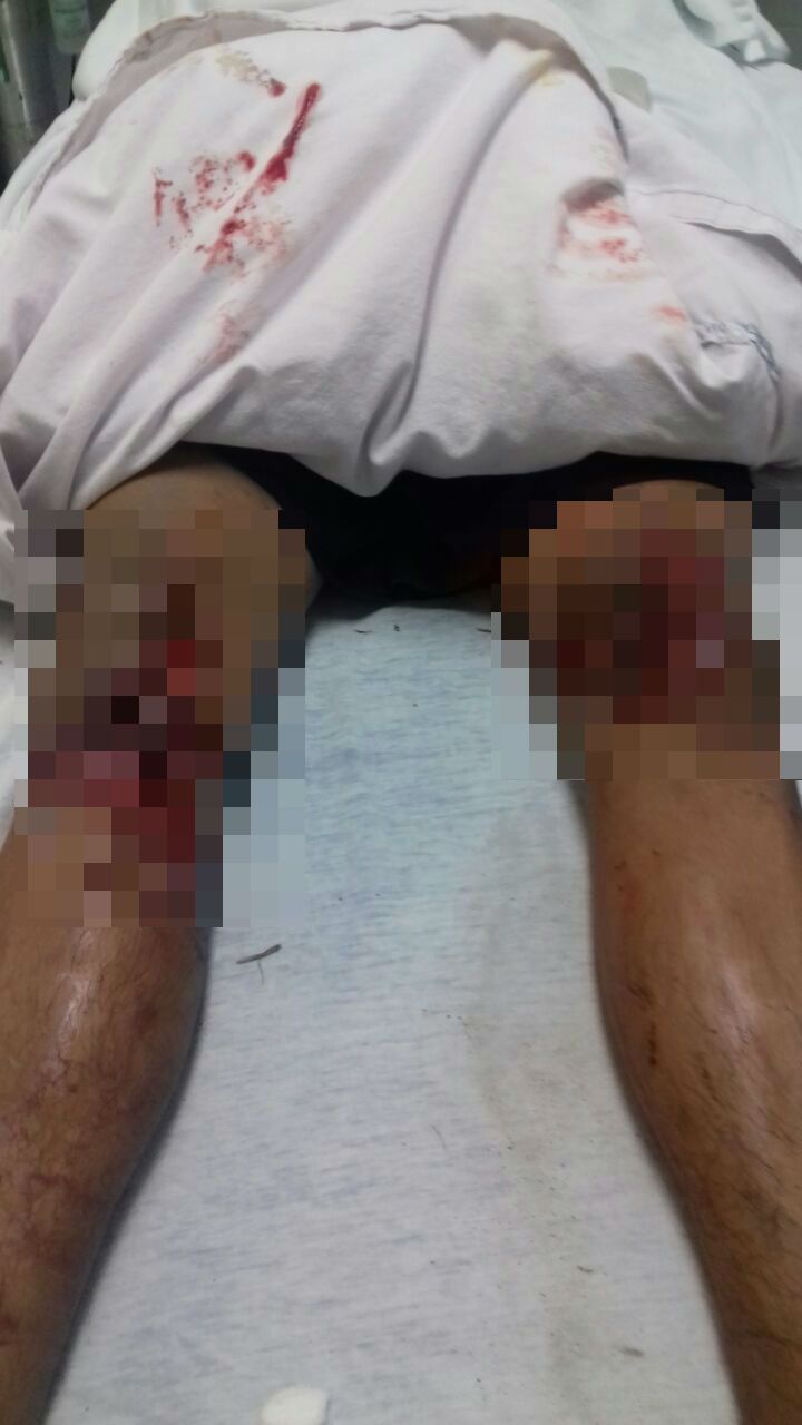 Atropellan a atleta paralímpico en Colima - herida