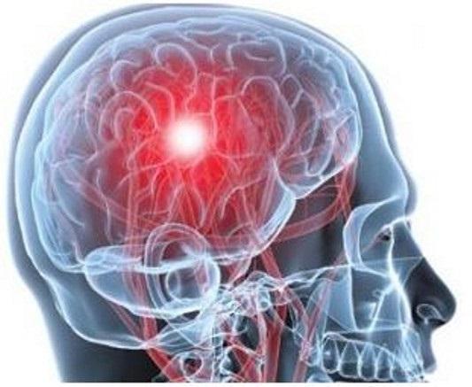 Reportan 100 mil casos de enfermedad cerebrovascular al año en México