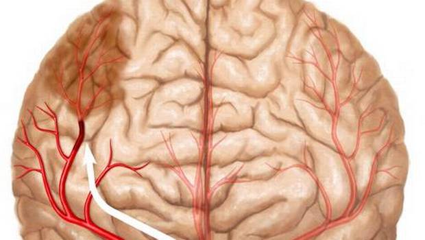Reportan 100 mil casos de enfermedad cerebrovascular al año en México - cerebrovascular