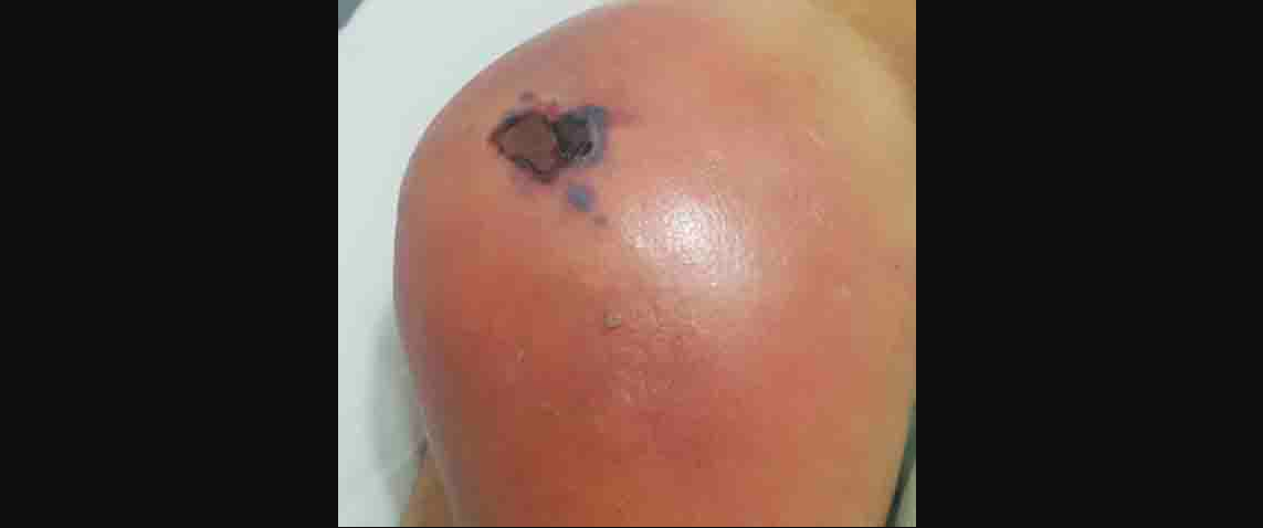 Muere una persona y 17 intoxicados por medicamento en Oaxaca