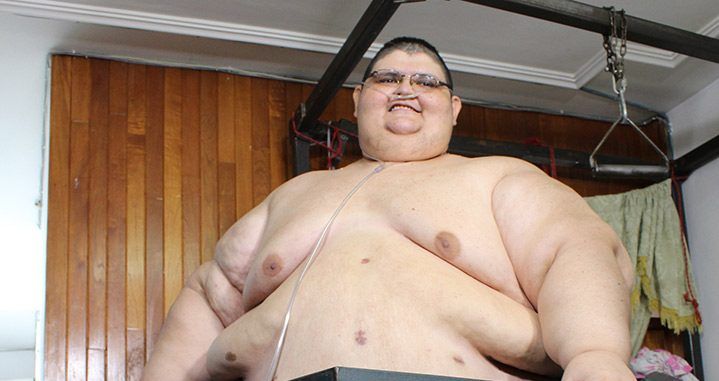 Hombre más obeso del mundo se somete a bypass gástrico