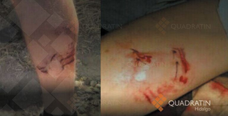 Ataque de perro deja tres lesionados en Hidalgo - perro-mordida-hidalgo