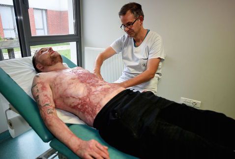 Hombre sobrevive con trasplante de piel en 95 por ciento de su cuerpo