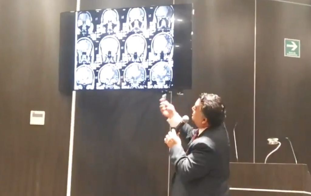 Mujer vuelve al trabajo tras extirparle tumor cerebral gigante