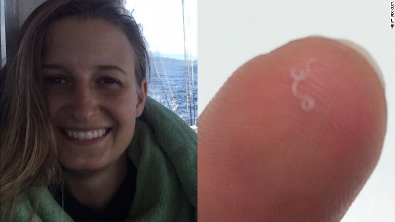 Retiran 14 gusanos de ojo de mujer en Oregon