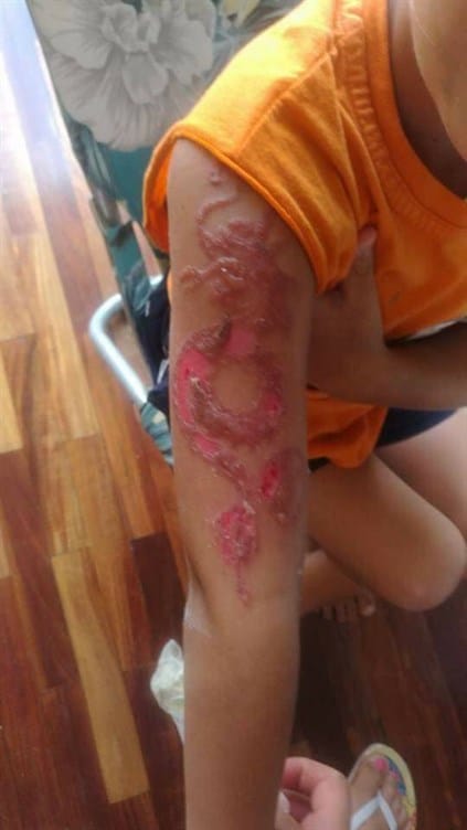 Menor sufre reacción alérgica a tatuaje de henna - nino-tatuaje-henna-alergia-3