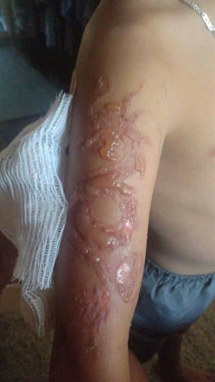 Menor sufre reacción alérgica a tatuaje de henna - nino-tatuaje-henna-alergia-4
