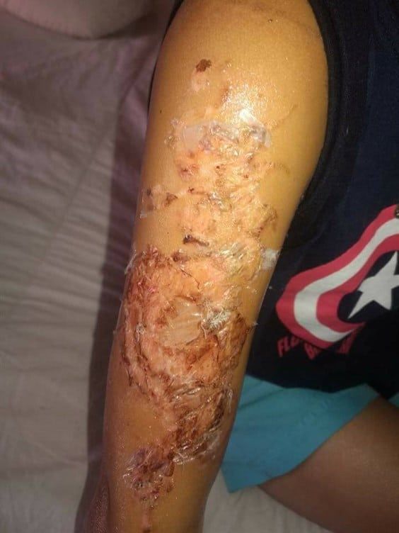 Menor sufre reacción alérgica a tatuaje de henna - nino-tatuaje-henna-alergia-5