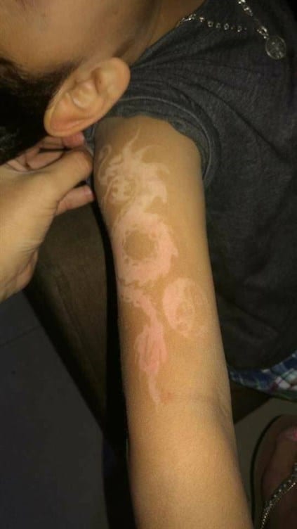 Menor sufre reacción alérgica a tatuaje de henna - nino-tatuaje-henna-alergia-6