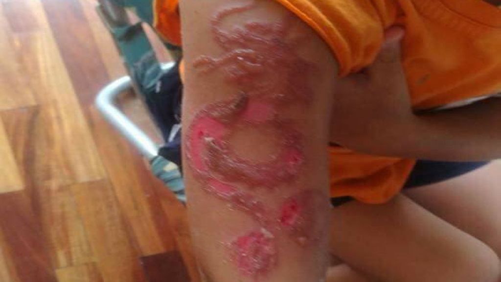 Menor sufre reacción alérgica a tatuaje de henna