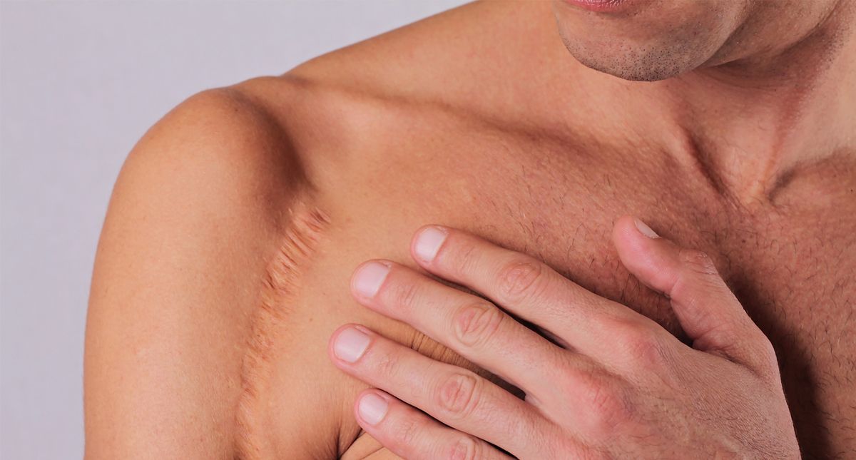 ¿Cómo afectan las cicatrices en la autoestima de las personas?