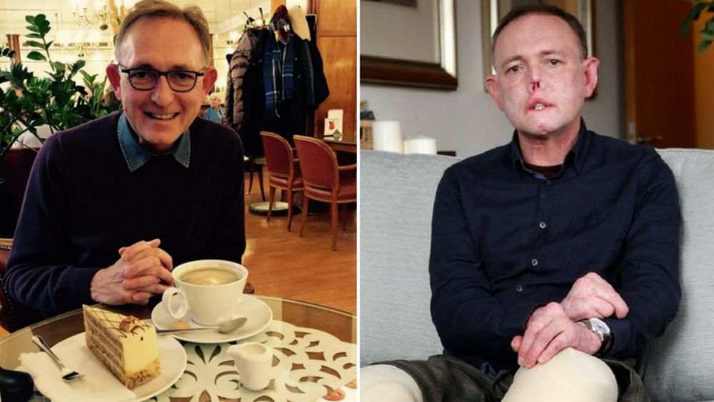 Hombre pierde piernas y parte de rostro por bacteria transmitida por su perro - jaco-nel