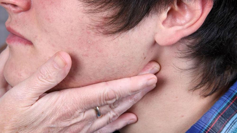 Emiten alerta por brote de paperas en escuelas