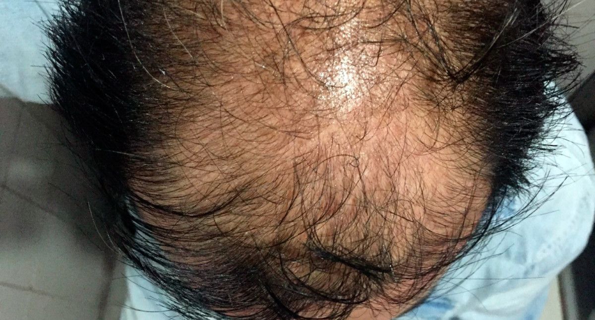 Dietas estrictas pueden provocar alopecia - alopecia-caida-del-cabello-pelo-2