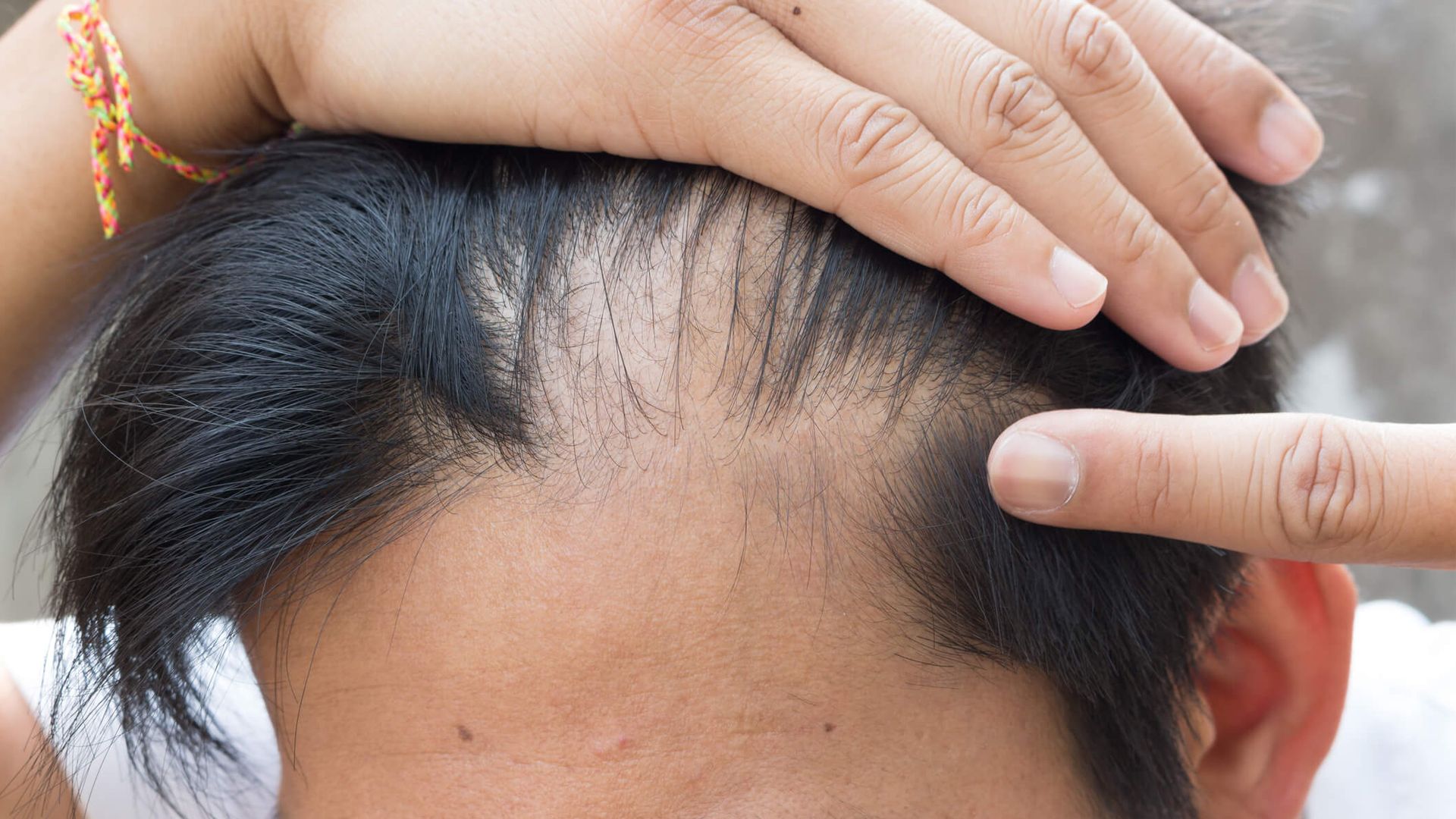 Dietas estrictas pueden provocar alopecia