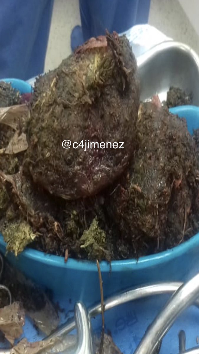 Mujer finge embarazo, pero ocultaba mariguana en el vientre - mujer-mariguana-oculta-hospital