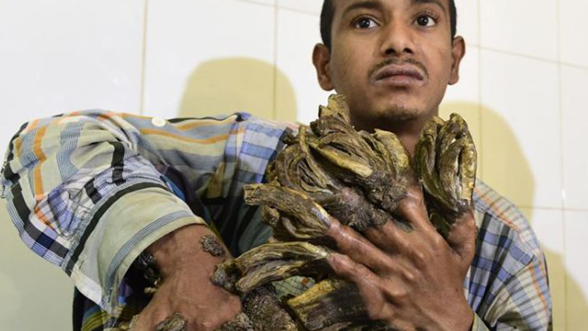 “Hombre árbol” abandona el hospital ante imposibilidad de curarse