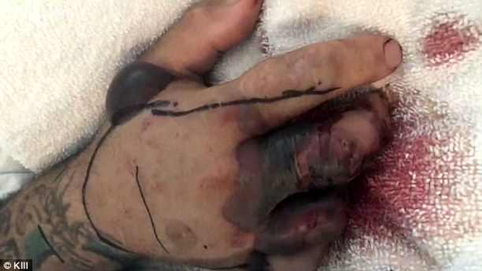 Hombre casi muere por mordedura de serpiente decapitada - milo-y-jennifer-sutcliffe-serpiente-texas-3