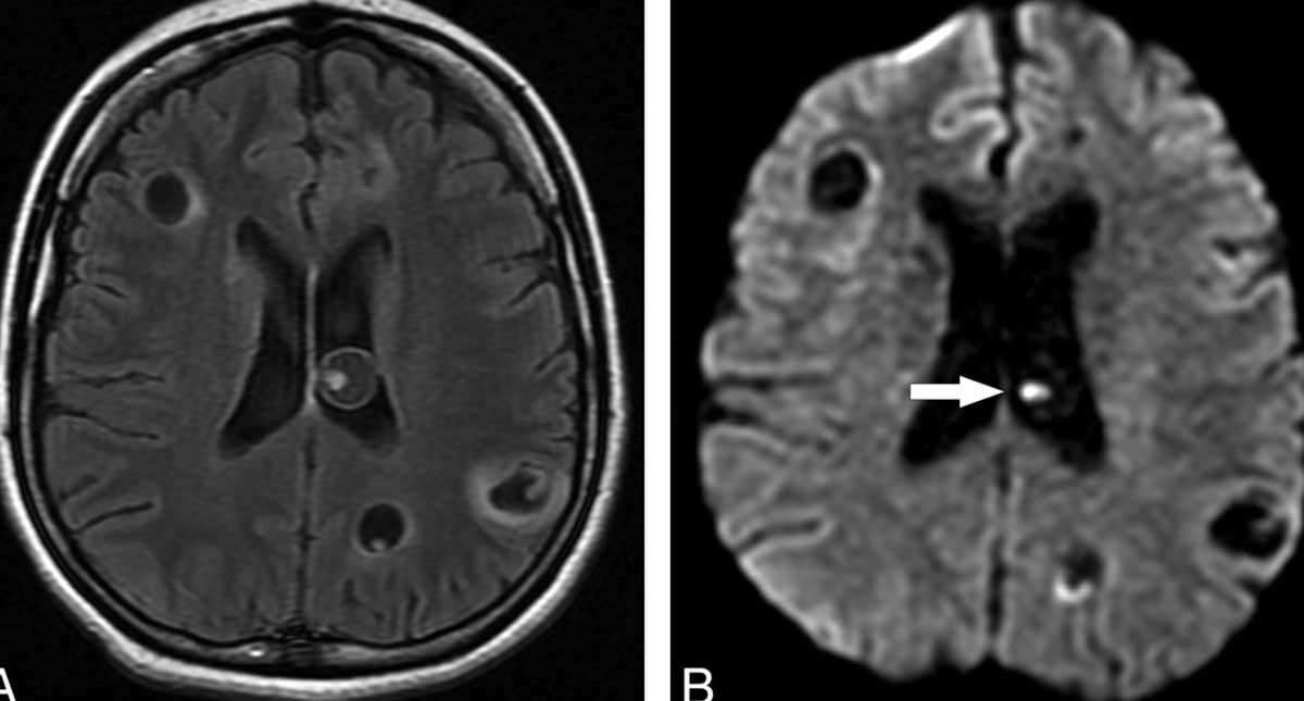 Extraen más de 100 larvas alojadas en cerebro de una niña