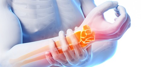 ¿Qué es el Síndrome del Túnel Carpiano? - tunel-carpiano-2