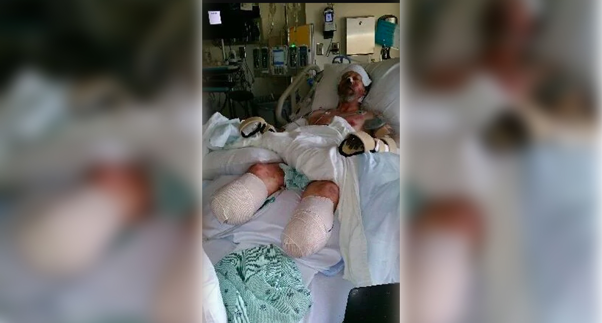 Amputan extremidades de hombre tras lamida de perro - greg-manteufel-manos-perro-amputaciones-2