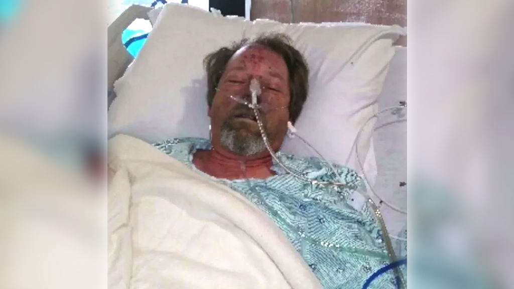 Amputan extremidades de hombre tras lamida de perro