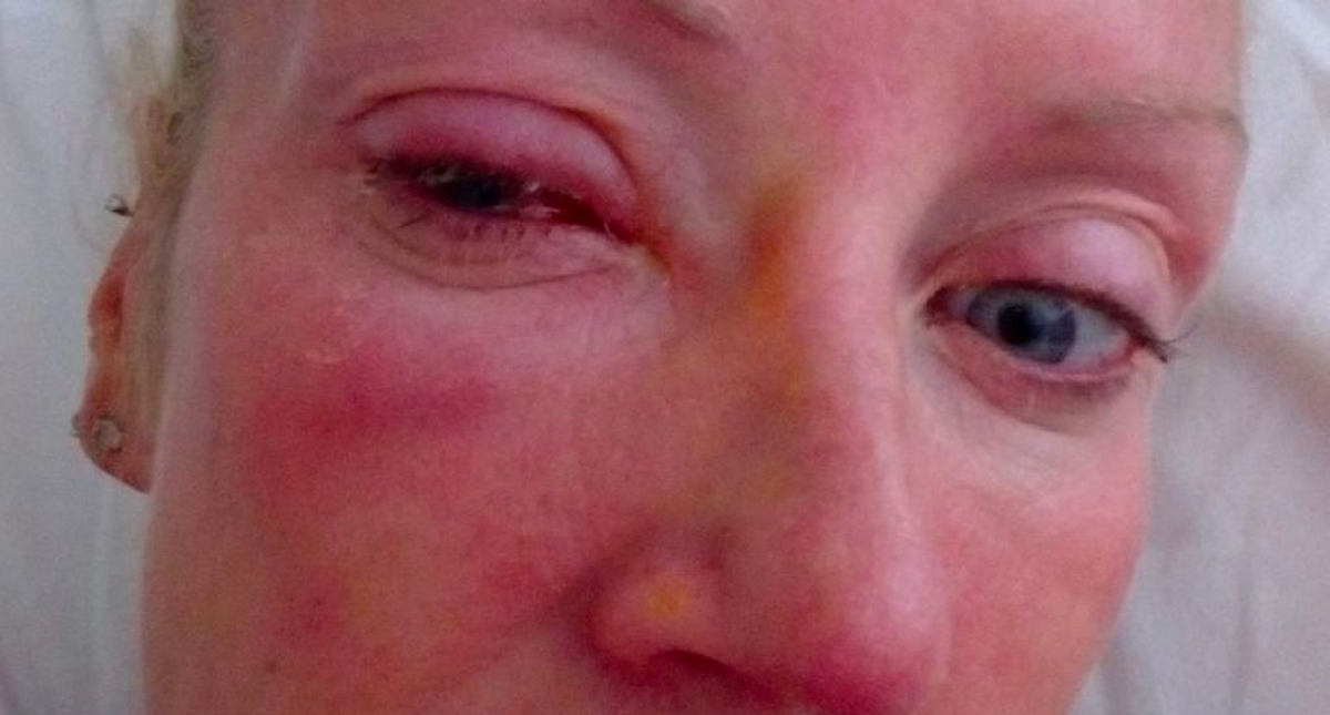 Mujer pierde la vista por bañarse con los lentes de contacto puestos