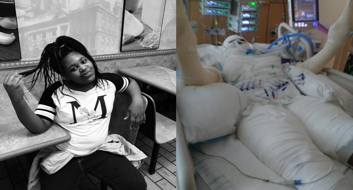 Niña se quema de las rodillas a la cabeza por reto viral