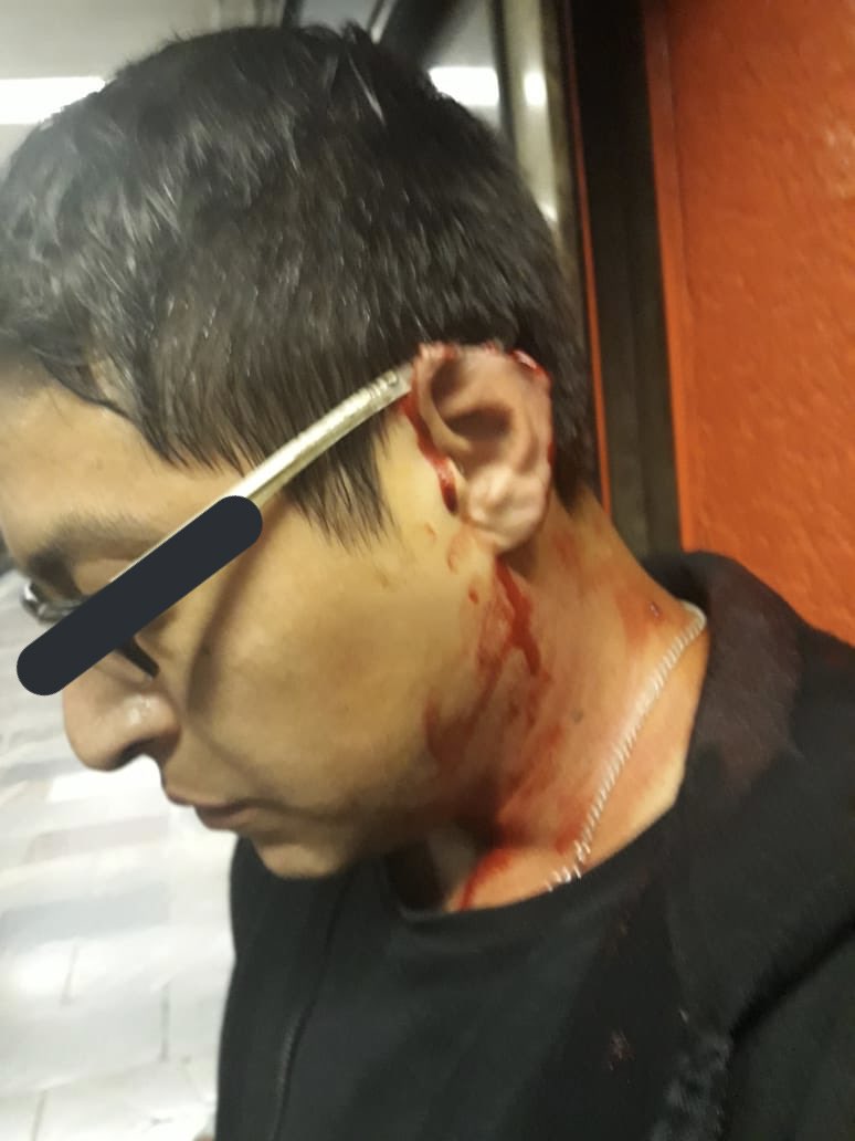 Hombre le arranca pedazo de oreja a otro durante riña en el Metro - oreja-metro