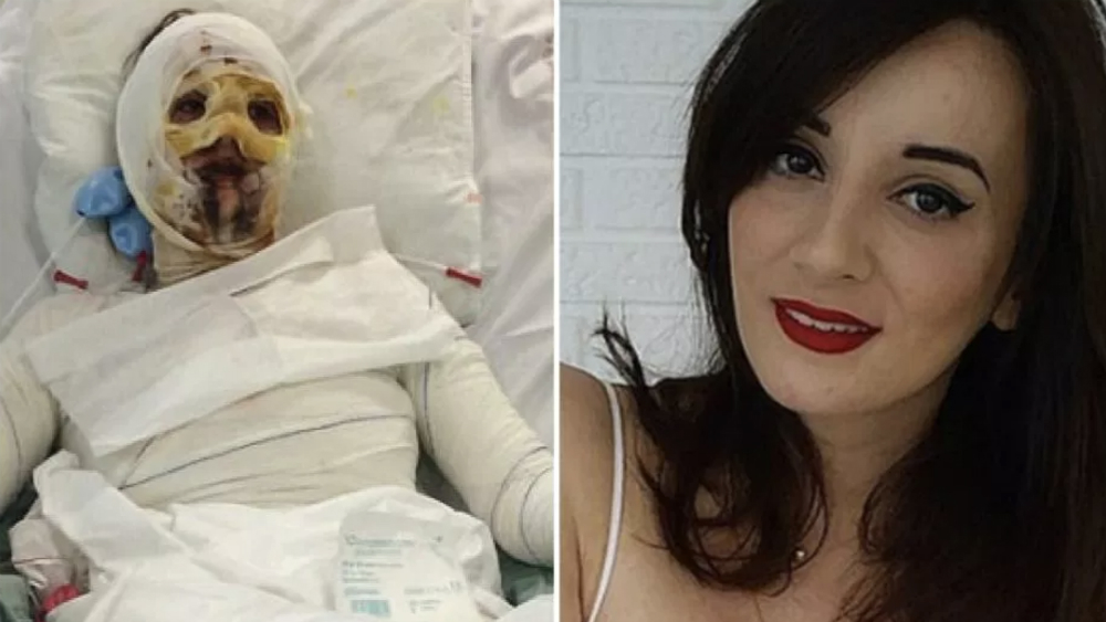 Mujer sufre quemaduras en el 90 por ciento de su cuerpo por alergia a penicilina - camille-lagier-2