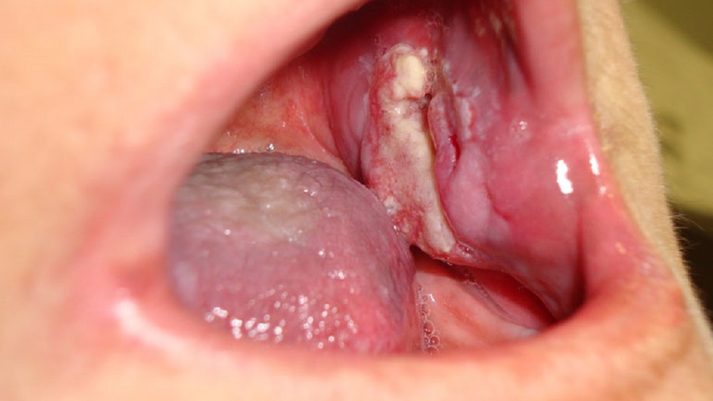 Relacionan cáncer bucal a la contaminación del aire - cancer-bucal