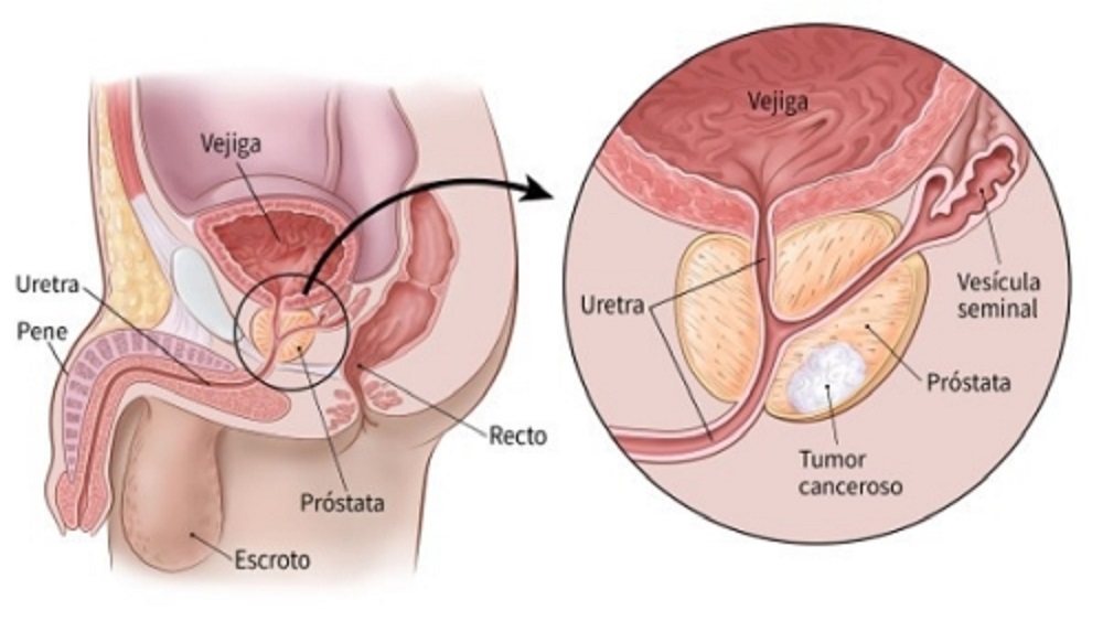 Cáncer de próstata mata a 15 hombres al día en México - cancer-de-prostata