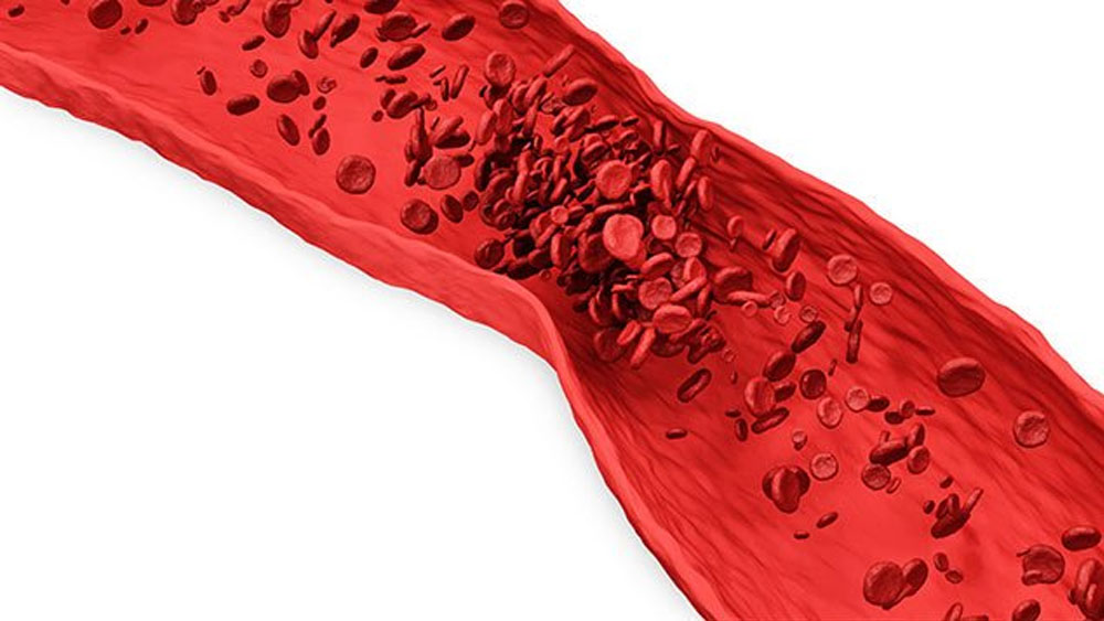 Trombosis causa una de cada cuatro muertes en el mundo