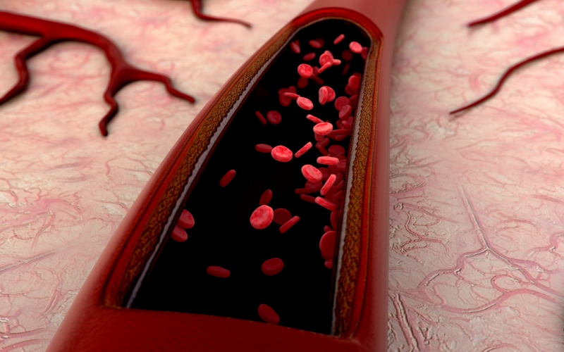 Trombosis causa una de cada cuatro muertes en el mundo - trombosis1