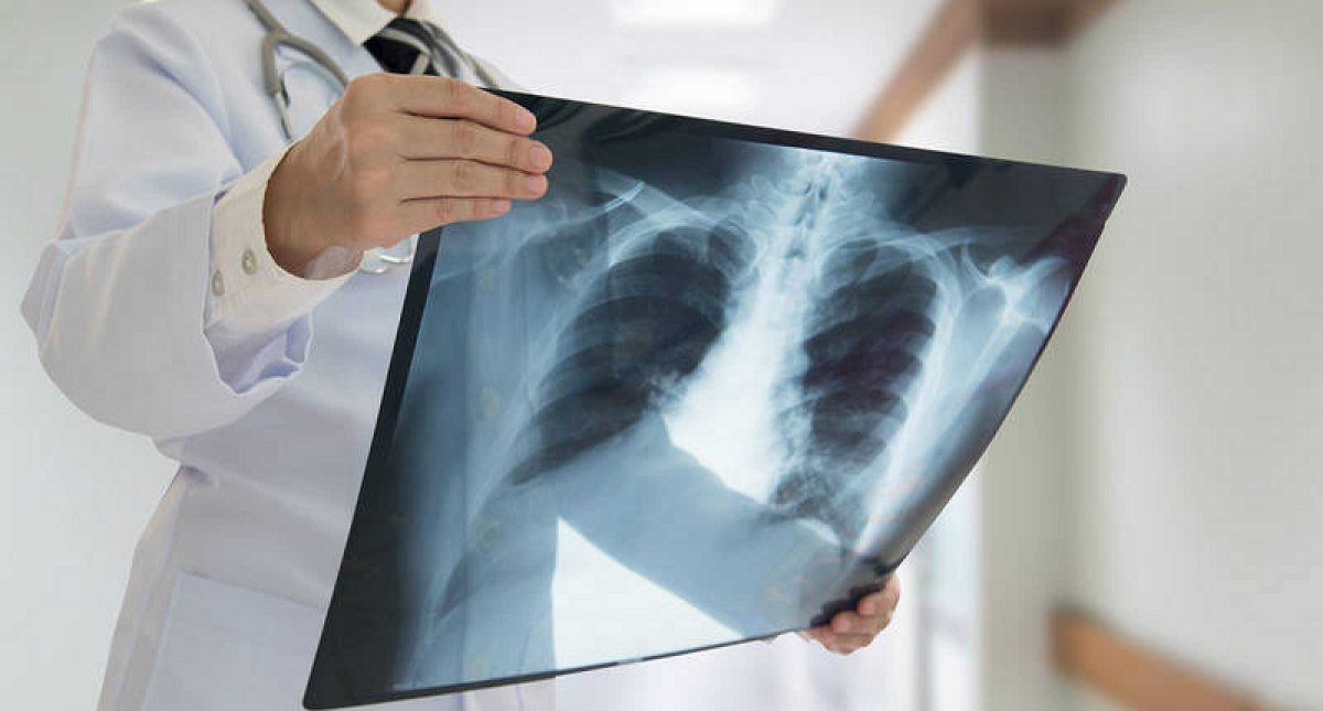 Cáncer de pulmón, el más mortal de América Latina