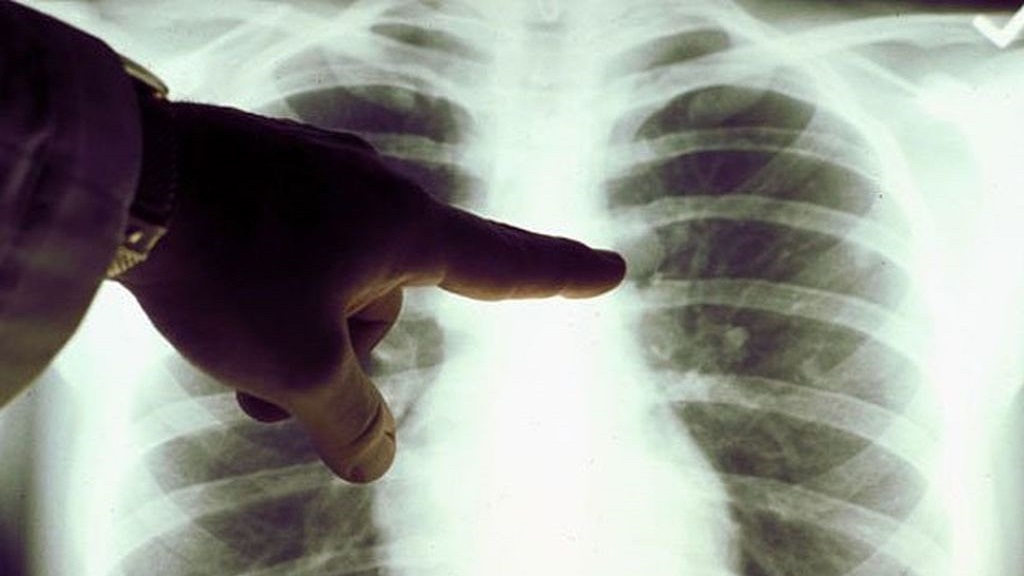 Cáncer de pulmón, el más mortal de América Latina - cancer-de-pulmon