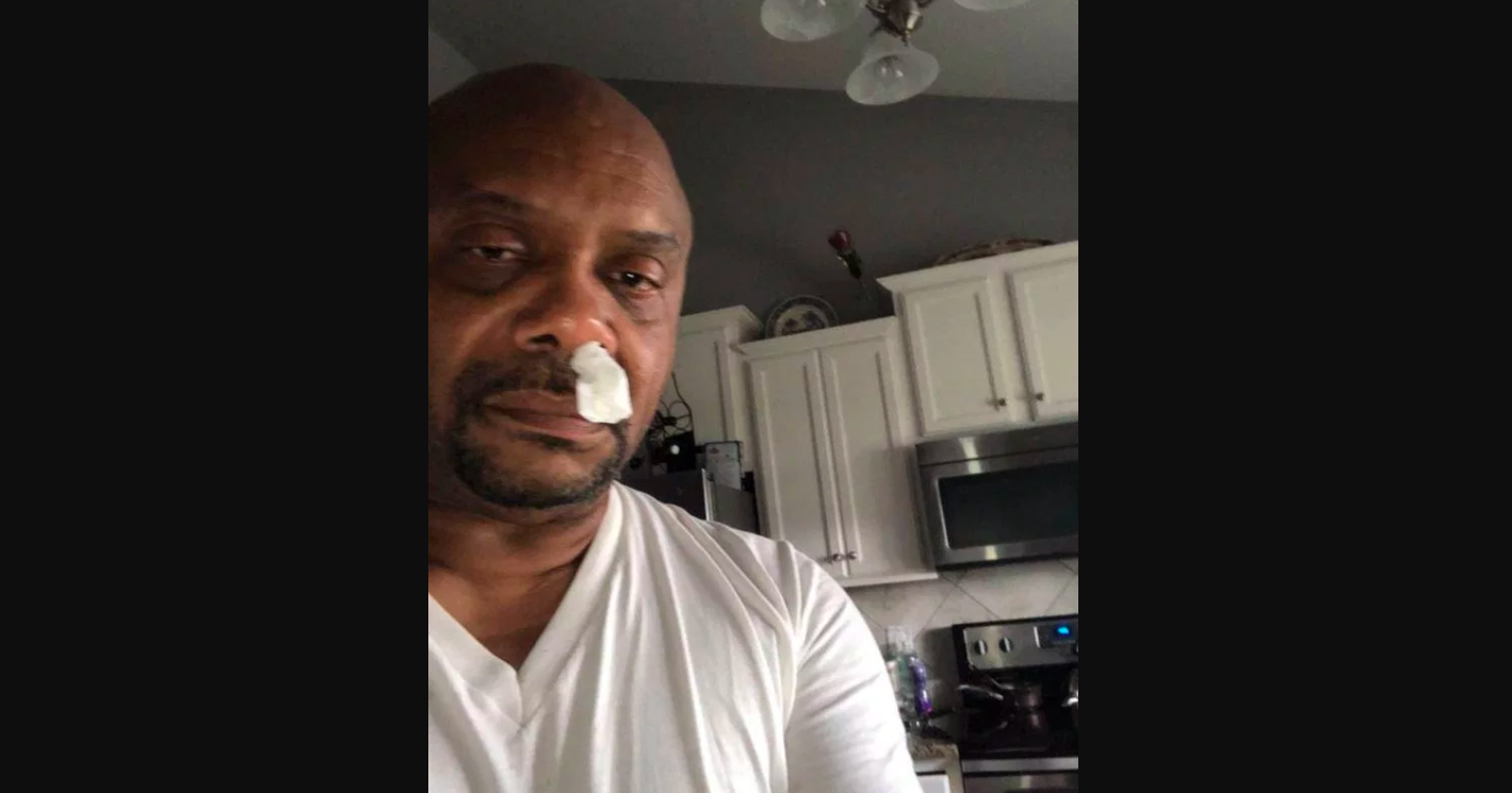 Hombre descubre que su escurrimiento nasal era líquido cefalorraquídeo