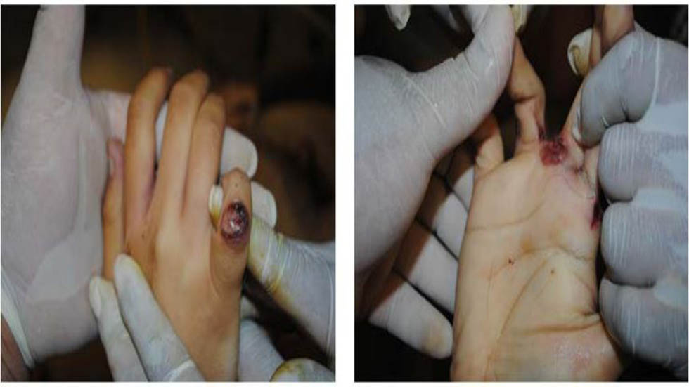 CNDH acredita uso ilegal de la fuerza de la Sedena contra familia - heridas-de-bala-hechas-a-la-hermana-de-la-victima