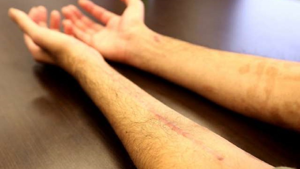 #Video Joven sobrevive a 30 balazos en Toronto - heridas-de-jamal