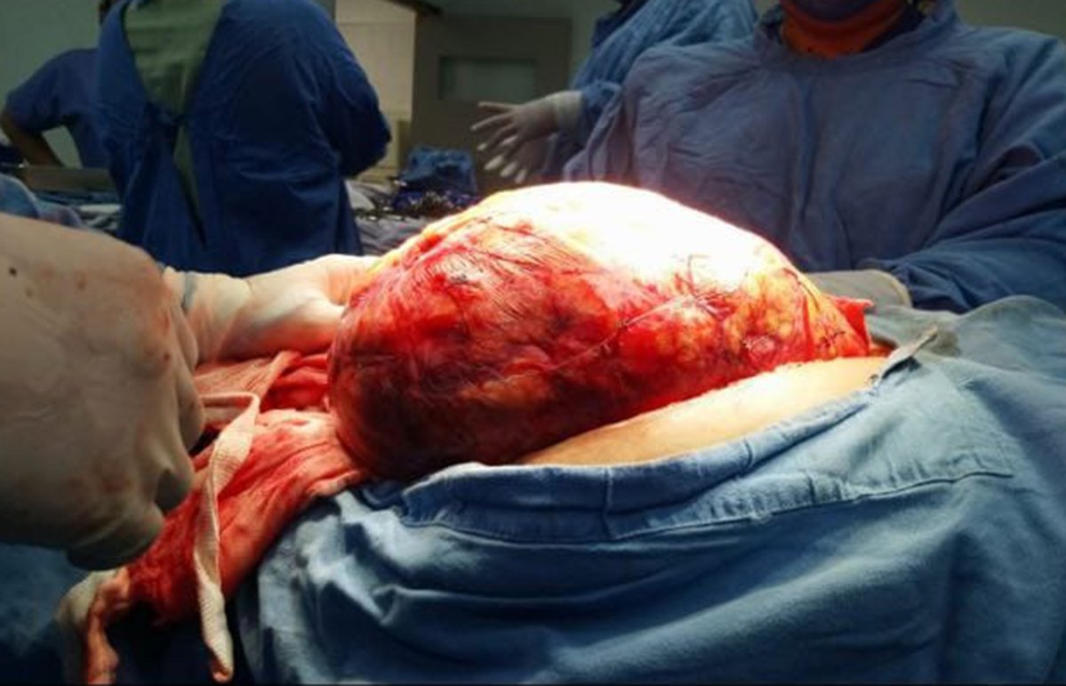 Extirpan tumor de 17 kilos a mujer en IMSS de Durango