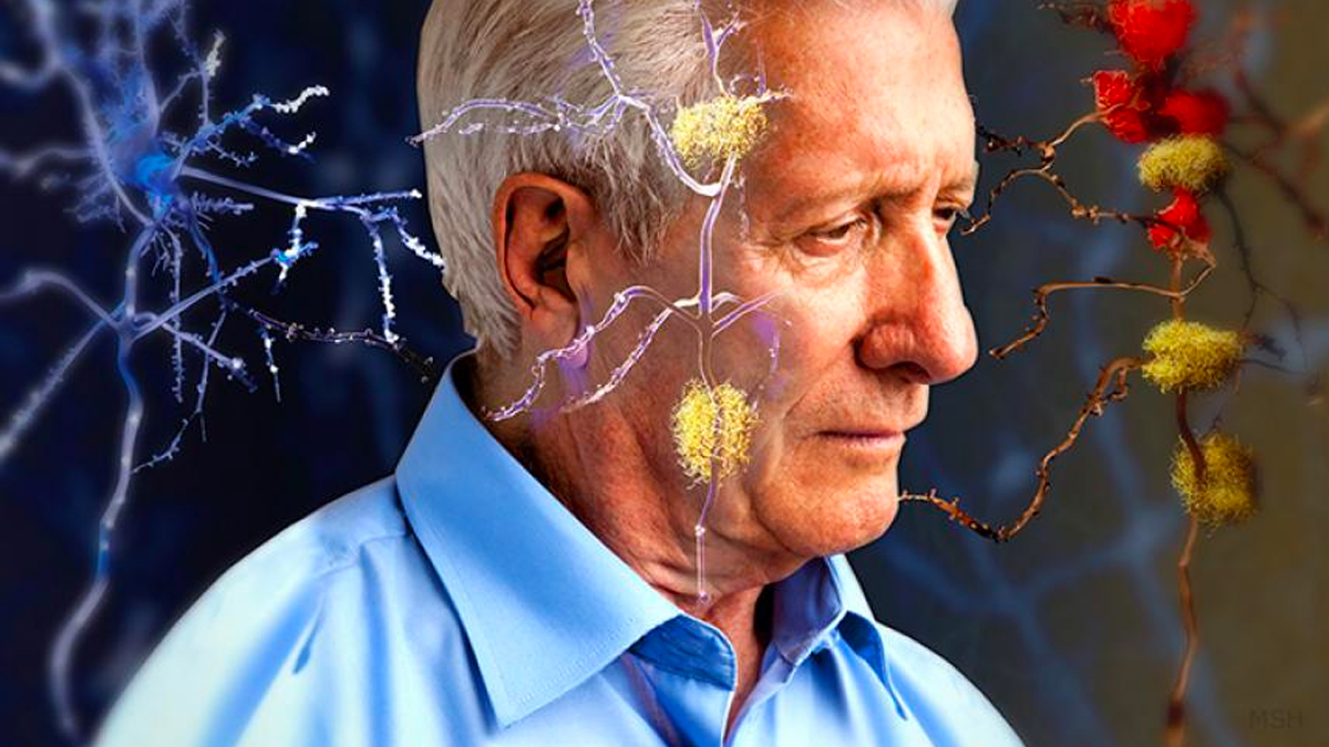 Científicos logran promisorios avances en la lucha contra el Alzheimer