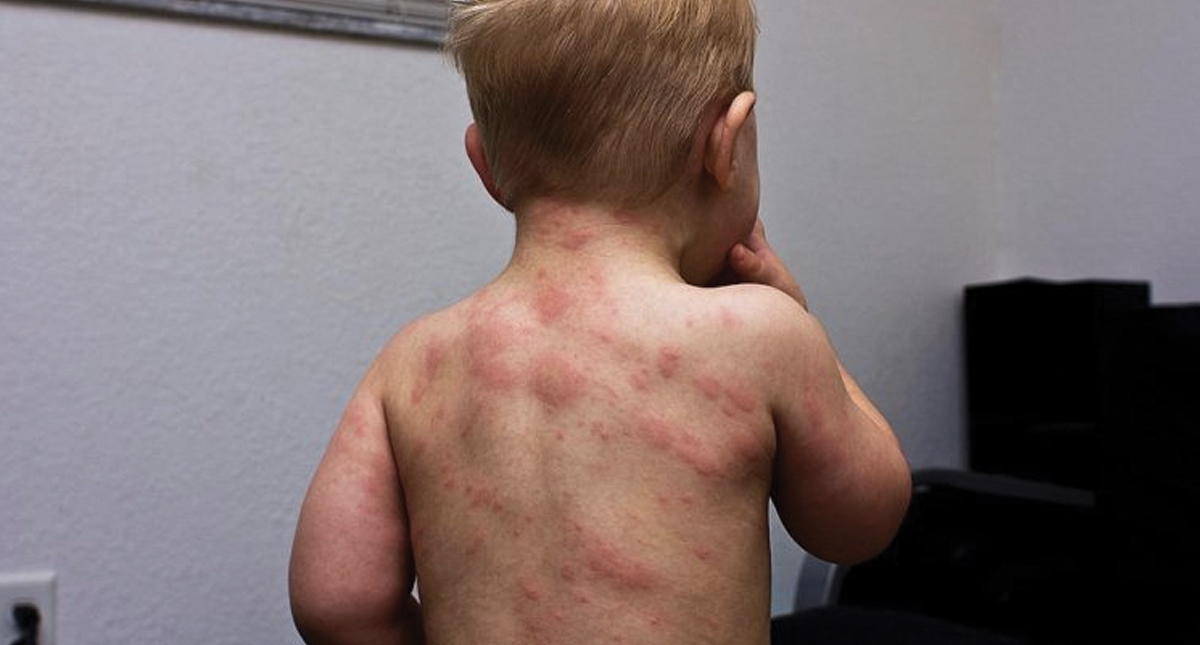 Unicef alerta sobre oleada mundial de casos de sarampión