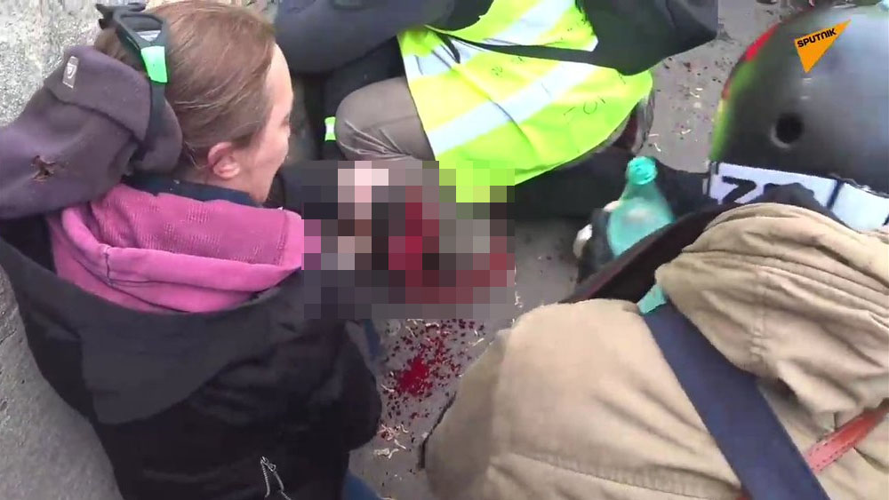 Manifestante pierde mano durante protesta de chalecos amarillos - chalecos-amrillos-mano