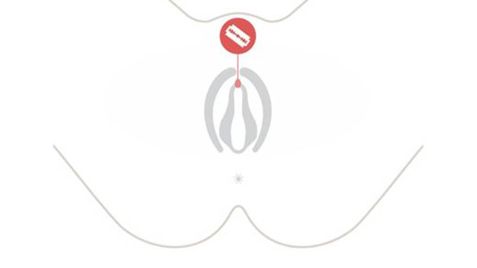 La mutilación genital femenina - clitoridectomia