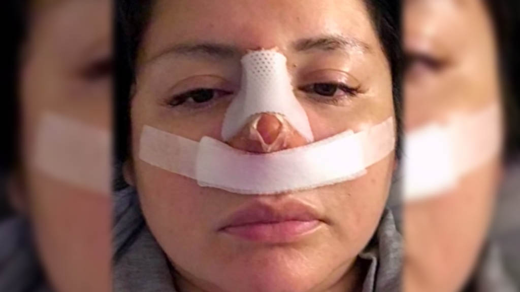 Viaja a Perú por una liposucción y le hacen una rinoplastia