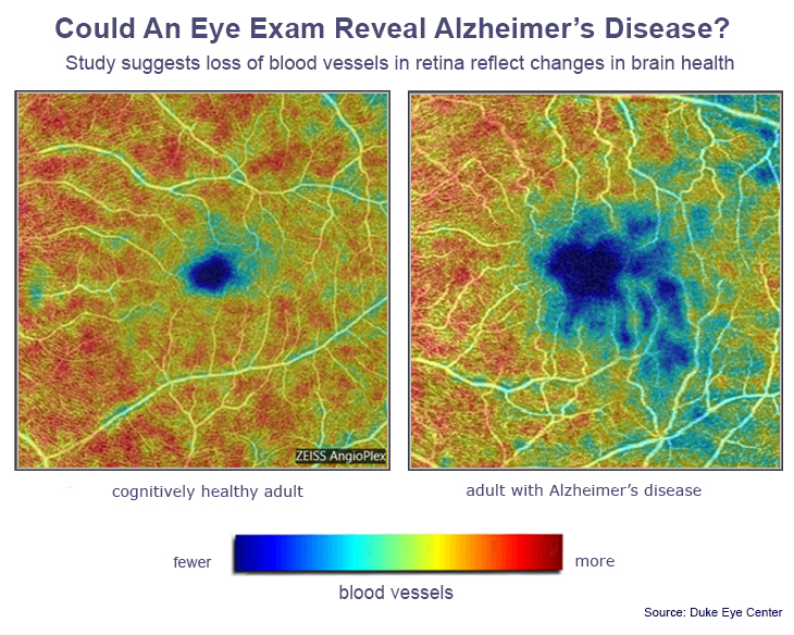 Examen de retina podría diagnosticar el Alzheimer - alzheimer-retina-informe